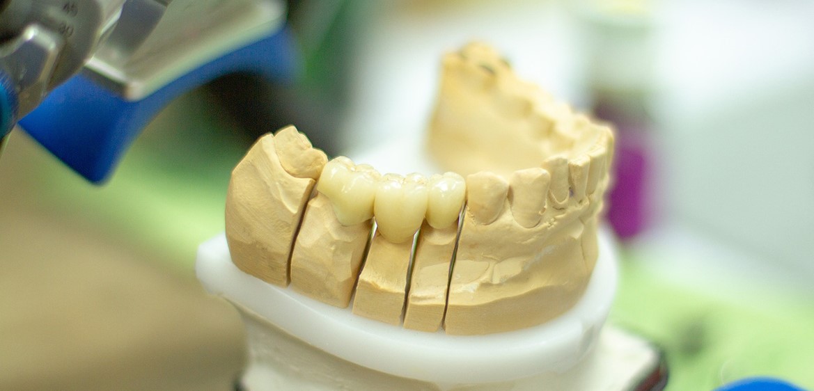Виды Протезирования Зубов Фото Цены