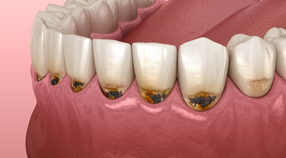 Кариес корня зуба: лечить или удалять? | Стоматология «Денталюкс-М» (Москва)