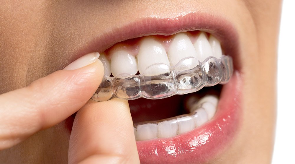 Капы или брекеты: что выбрать для выравнивания зубов в ортодонтической стоматологии