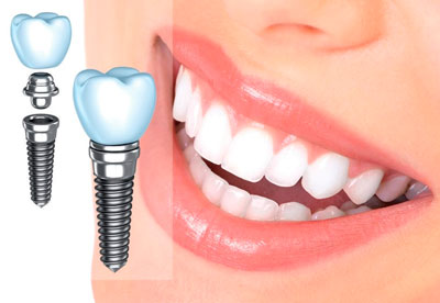 Имплантация Osstem - 32990 руб