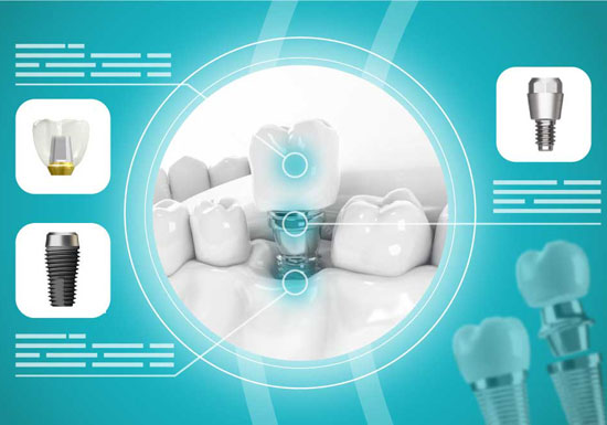 Имплантация OSSTEM под ключ